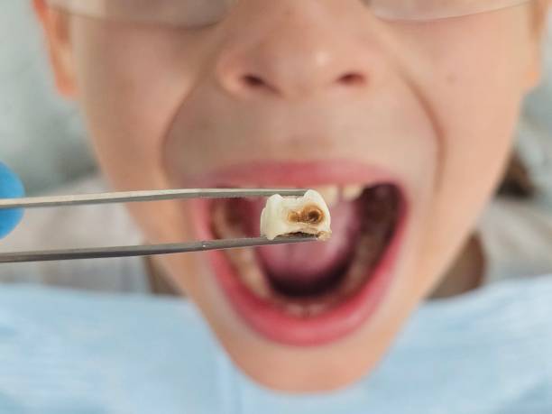 Best Emergency Root Canal Treatment in Gibson, AR